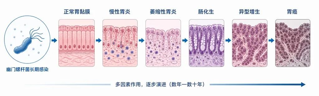 幽门螺杆菌导致胃癌演变的Correa级联反应示意图，展示从正常胃黏膜、慢性胃炎到胃癌的六个病理演变阶段。