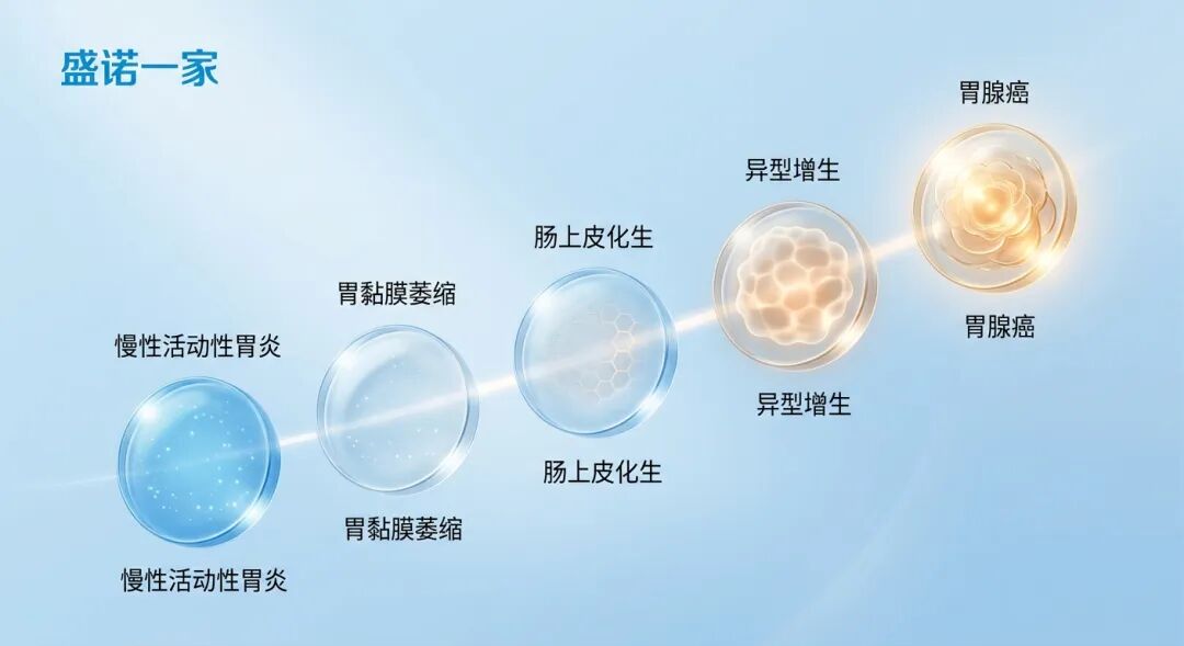 一张专业且具有国际化美感的医学插图，展示了‘科雷亚级联’的五个病理阶段：从慢性活动性胃炎、胃黏膜萎缩、肠上皮化生，到异型增生，最后演变为胃腺癌。画面采用品牌蓝调，通过五个半透明的微观组织切片意象呈现递进关系，最后两个阶段融入了温暖的琥珀色和金色光芒，整体风格干净、通透，传递出医学的严谨与希望。