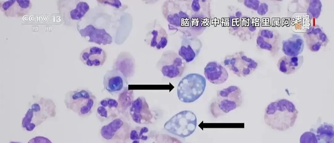 食脑虫