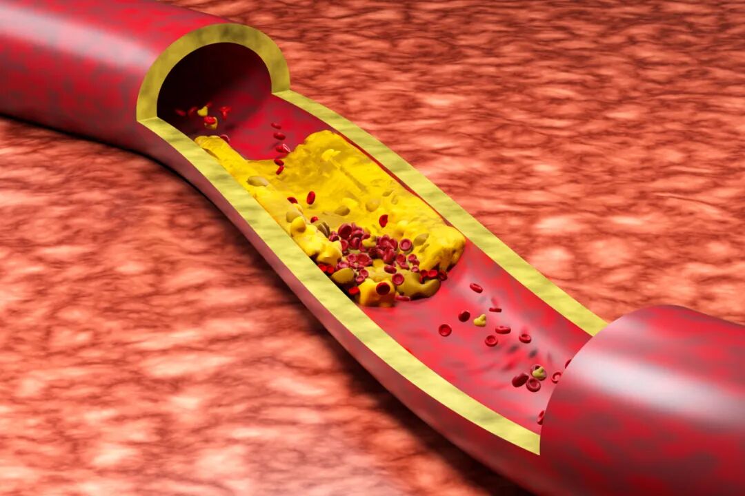 三氧疗法怎么代理三氧大自血疗法助力患者高血脂快速下降_https://www.jmylbn.com_新闻资讯_第4张