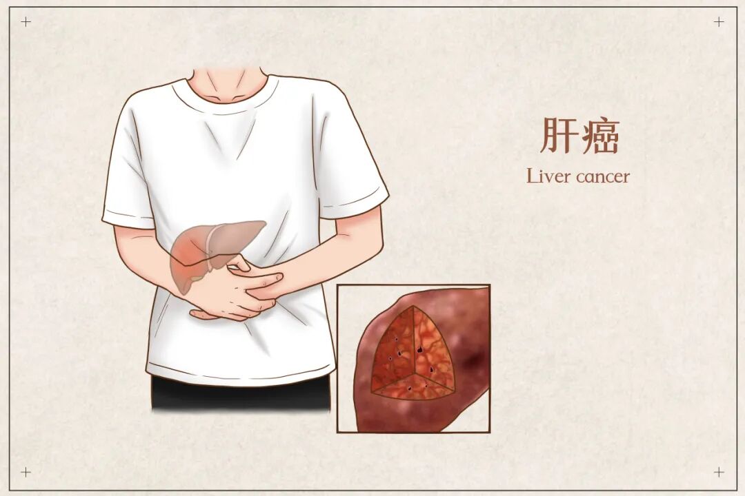 微波针是什么一根细针就能治疗肝癌？——一文带您了解肝癌微波消融术_https://www.jmylbn.com_新闻资讯_第4张