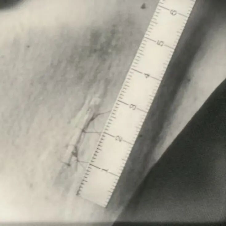 一到夏天就有尴尬体味怎么办？市五院皮肤科帮您告别腋臭