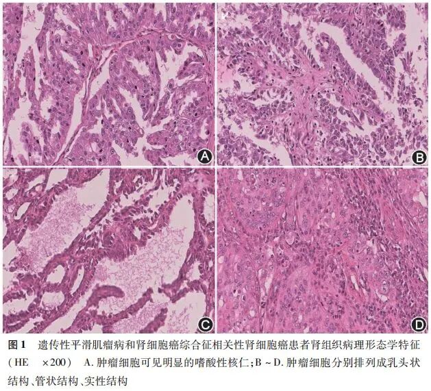 fh染色是什么意思【临床研究】遗传性平滑肌瘤病和肾细胞癌综合征相关性肾癌的临床特征分析：一项全国多中心回顾性研究_https://www.jmylbn.com_新闻资讯_第6张