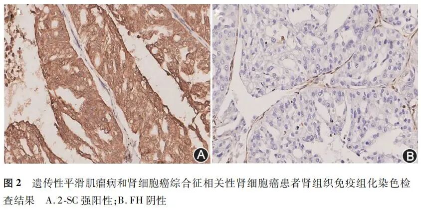 fh染色是什么意思【临床研究】遗传性平滑肌瘤病和肾细胞癌综合征相关性肾癌的临床特征分析：一项全国多中心回顾性研究_https://www.jmylbn.com_新闻资讯_第7张