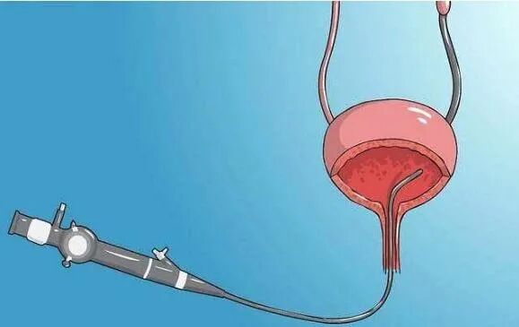 b膀胱镜为什么消毒泌尿外科医生的好帮手：膀胱镜检查_https://www.jmylbn.com_新闻资讯_第6张