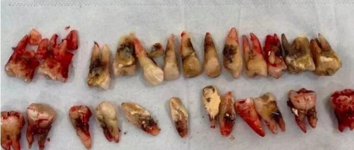 第一批90后已开始掉牙！为什么很多人逃不过牙齿掉光的宿命？