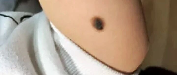 你身上的痣会癌变吗？医生分析了100多颗黑痣，快来对照下！