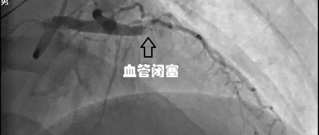 心内科医生整理的7个心梗教训！很多人都是被自己坑死的！