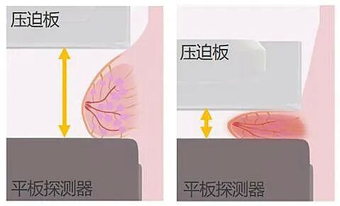 乳腺dr能检查什么乳腺隐疾的小病灶无所遁形——任泽区人民医院医疗新武器→富士乳腺断层DR（放射科）_https://www.jmylbn.com_新闻资讯_第10张