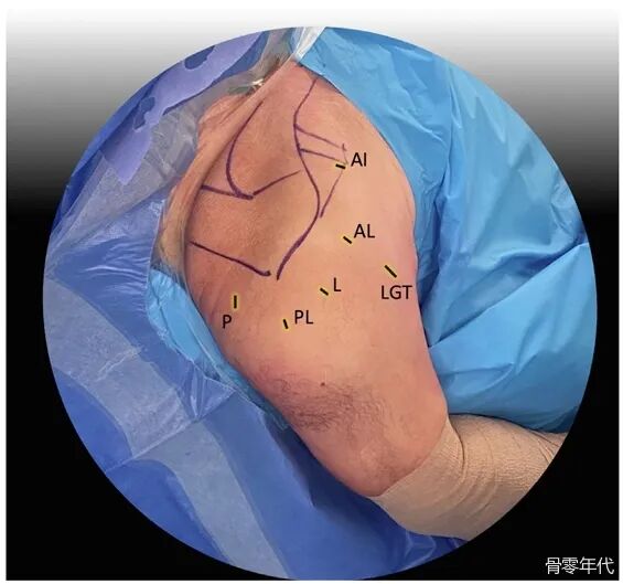 关节镜下降落伞技术治疗大结节骨折