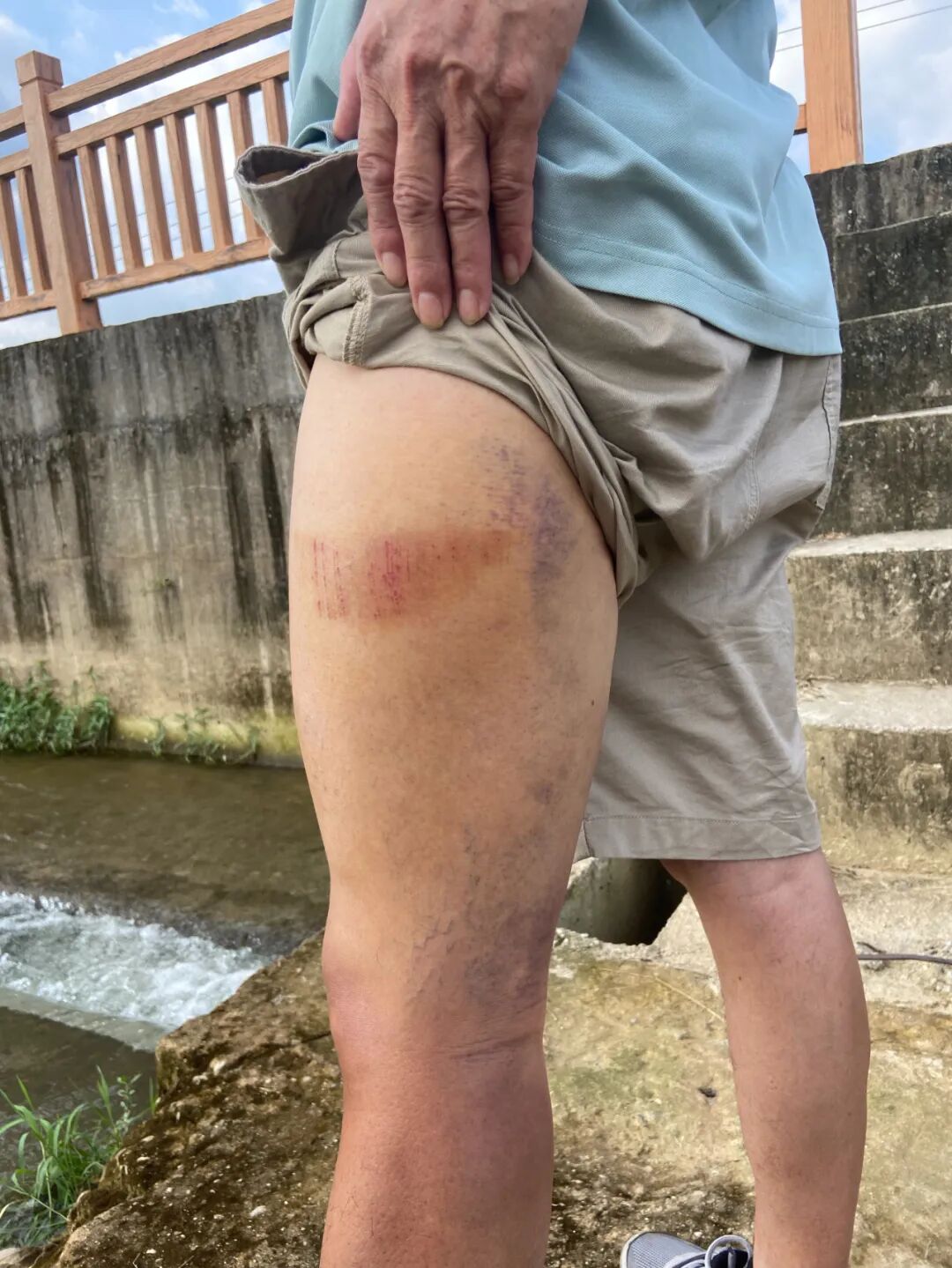 （为救人，脚部被擦伤）