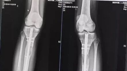 断骨为长高，16万买来7.2cm和一身“残疾”？如果他能早学点中医知识……