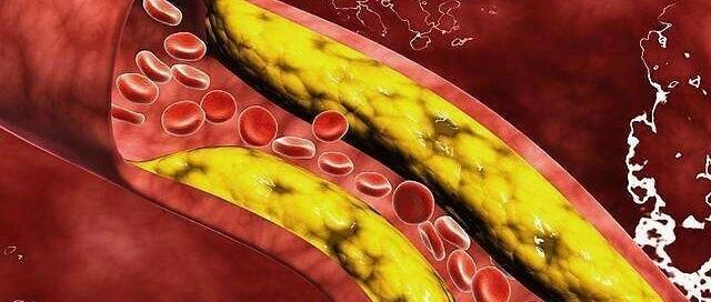 这种疾病死亡率高于肿瘤！做好这几点，助力健康生活