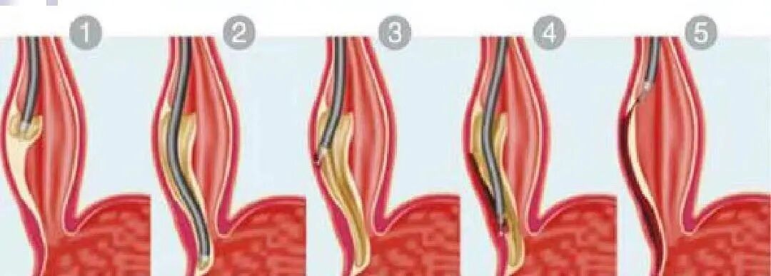 吞咽5900怎么使用【精湛医术】吞咽困难6年都找不到病因，在这里“一镜”解决病痛_https://www.jmylbn.com_新闻资讯_第6张