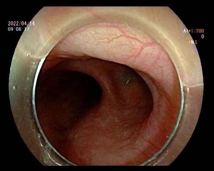 吞咽5900怎么使用【精湛医术】吞咽困难6年都找不到病因，在这里“一镜”解决病痛_https://www.jmylbn.com_新闻资讯_第3张