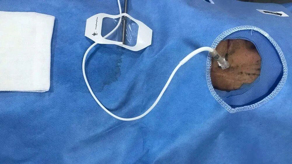 双极射频是什么山一大二附院疼痛科：三叉神经半月节双极脉冲射频调节术解除疼痛困扰_https://www.jmylbn.com_新闻资讯_第5张