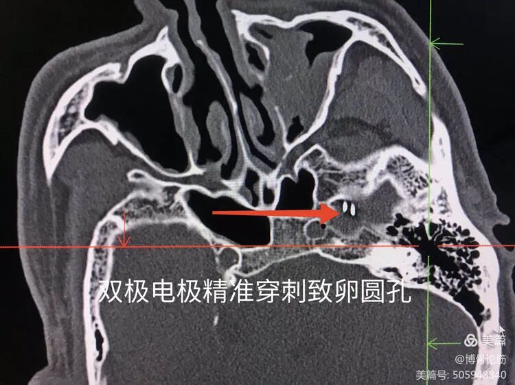 双极射频是什么山一大二附院疼痛科：三叉神经半月节双极脉冲射频调节术解除疼痛困扰_https://www.jmylbn.com_新闻资讯_第8张