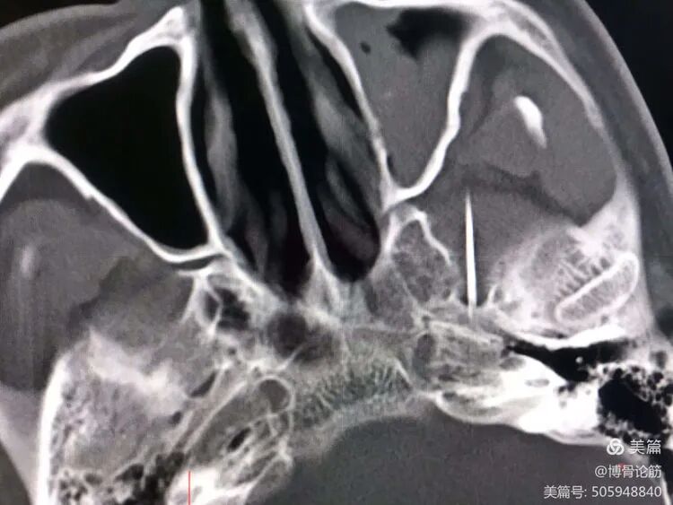 双极射频是什么山一大二附院疼痛科：三叉神经半月节双极脉冲射频调节术解除疼痛困扰_https://www.jmylbn.com_新闻资讯_第13张