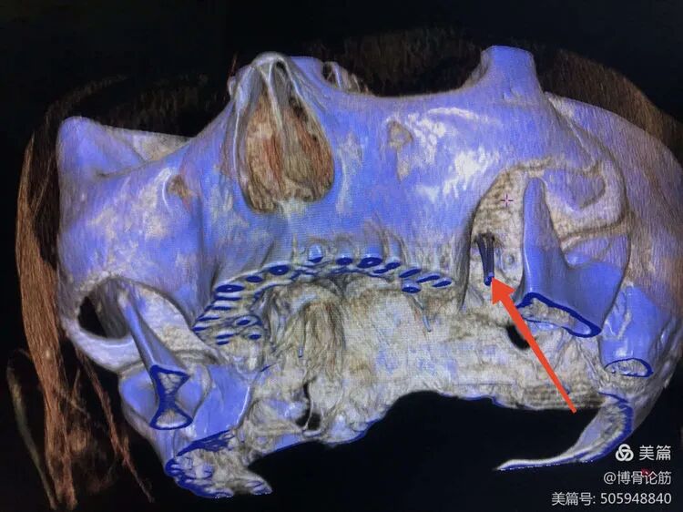 双极射频是什么山一大二附院疼痛科：三叉神经半月节双极脉冲射频调节术解除疼痛困扰_https://www.jmylbn.com_新闻资讯_第11张