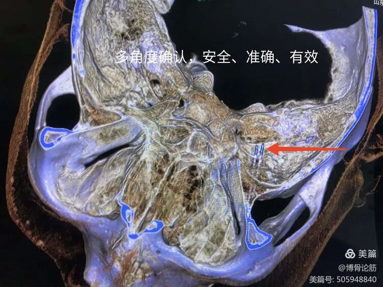 双极射频是什么山一大二附院疼痛科：三叉神经半月节双极脉冲射频调节术解除疼痛困扰_https://www.jmylbn.com_新闻资讯_第10张