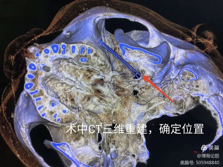 双极射频是什么山一大二附院疼痛科：三叉神经半月节双极脉冲射频调节术解除疼痛困扰_https://www.jmylbn.com_新闻资讯_第9张