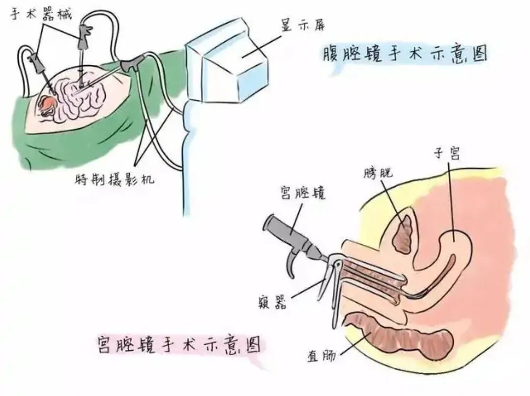 妇科有什么刀山一大二附院妇科：子宫内膜的“保护侠”——宫腔镜“冷刀”技术-上海聚慕医疗器械有限公司