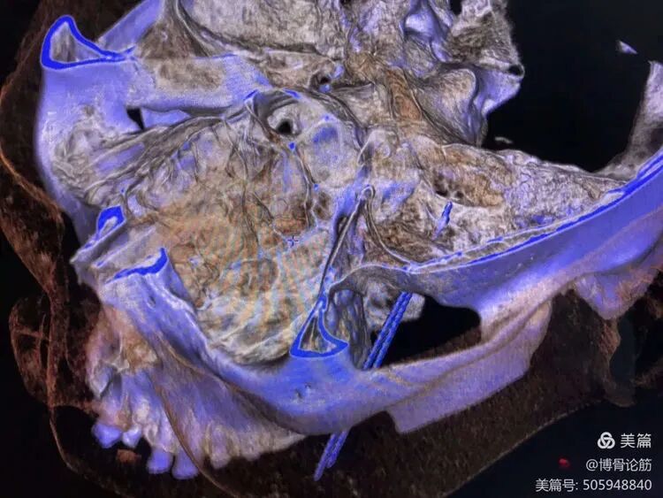 双极射频是什么山一大二附院疼痛科：三叉神经半月节双极脉冲射频调节术解除疼痛困扰_https://www.jmylbn.com_新闻资讯_第6张