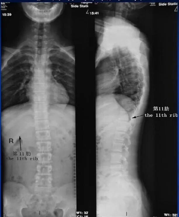 数字胃肠透视怎么做【先进设备】放射检查的“高清透视镜”：西门子Luminos dRF Max超高端数字胃肠机开启运行_https://www.jmylbn.com_新闻资讯_第18张