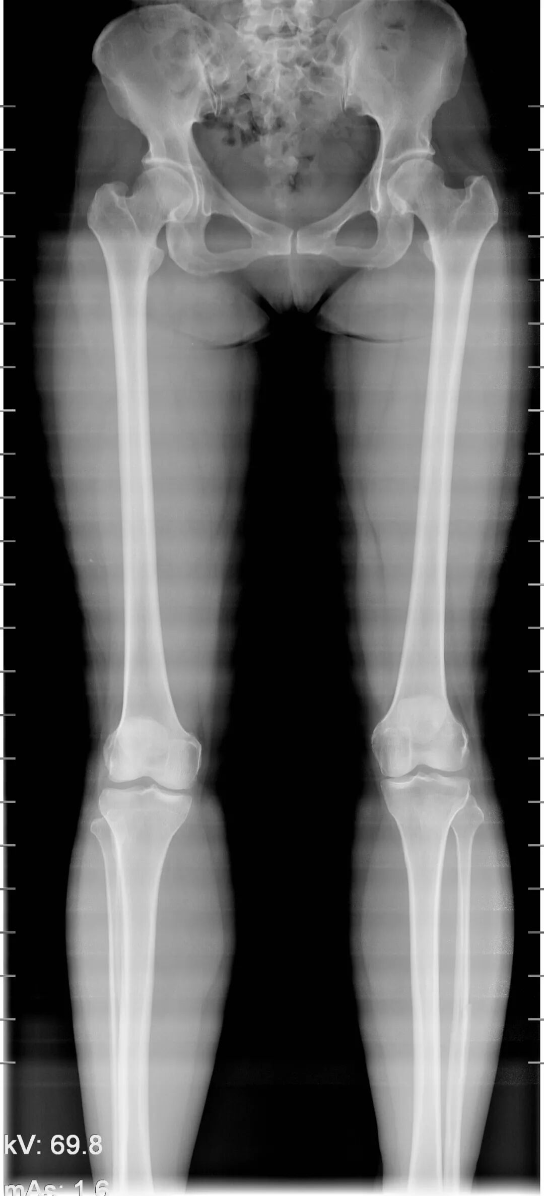 数字胃肠透视怎么做【先进设备】放射检查的“高清透视镜”：西门子Luminos dRF Max超高端数字胃肠机开启运行_https://www.jmylbn.com_新闻资讯_第17张