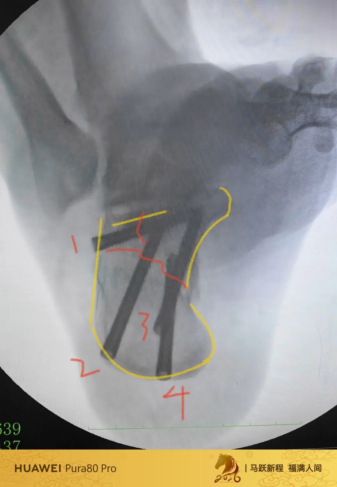 跟骨微创，无需等待消肿，无需担心切口感染、皮肤坏死
