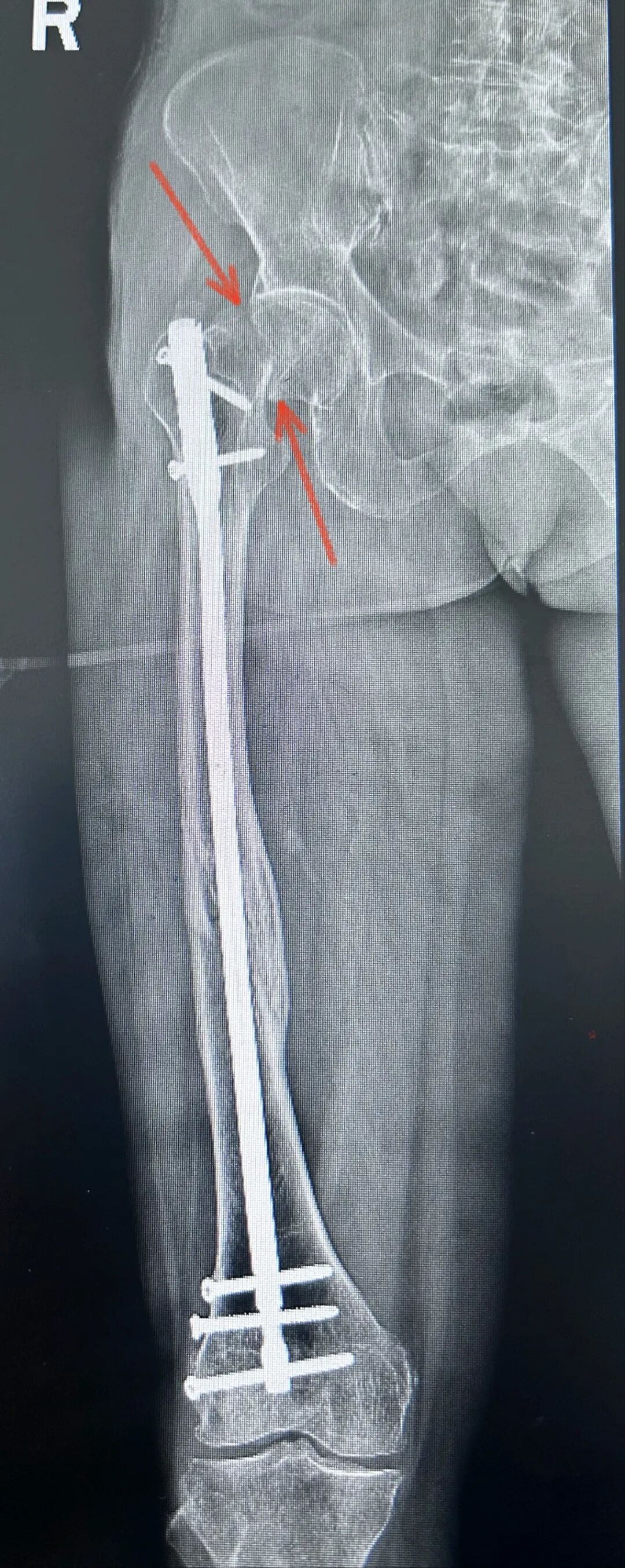 股骨干骨折为什么要“顶天立地”“能顺行不逆行”