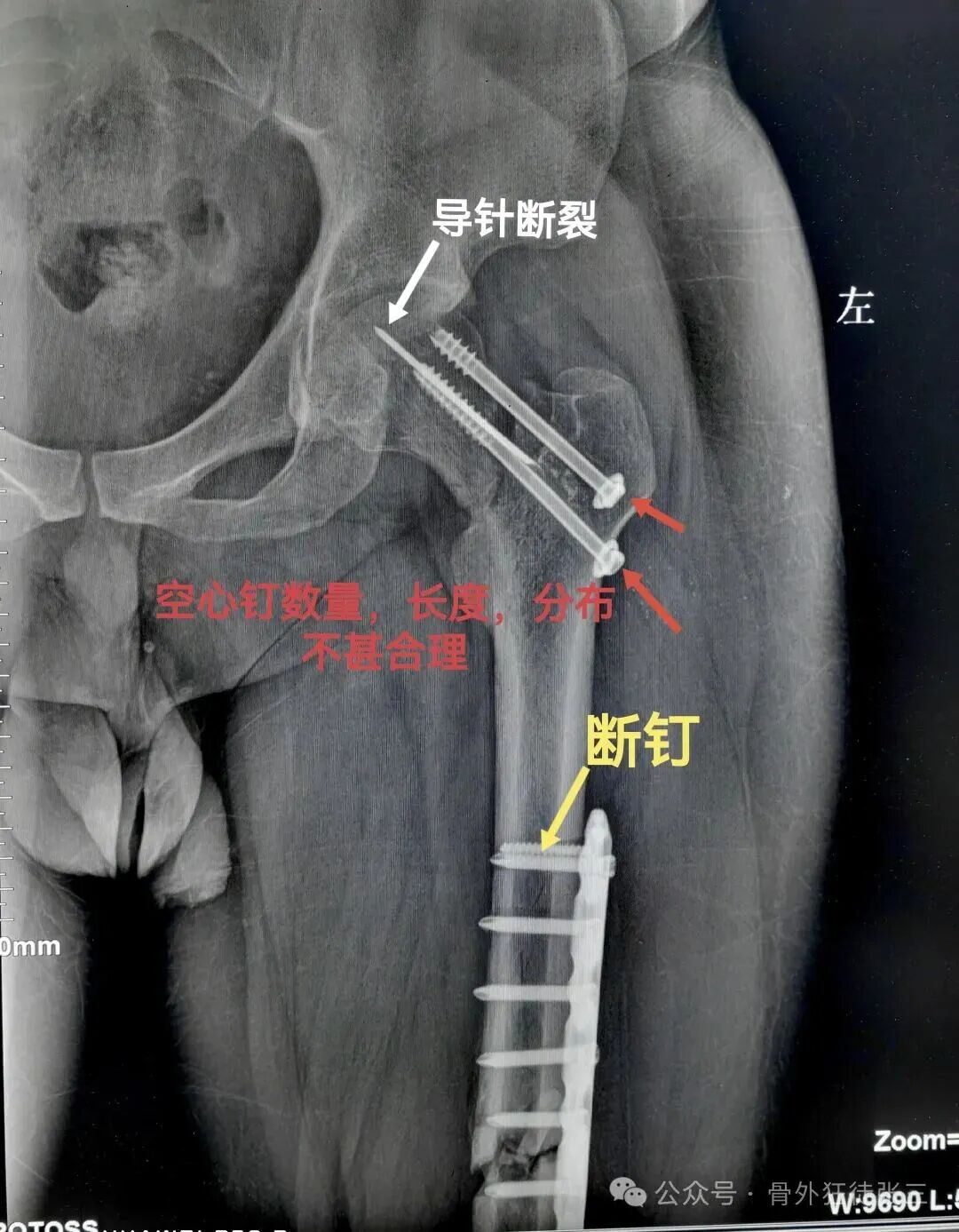两例锁定板动力化，长势喜人！