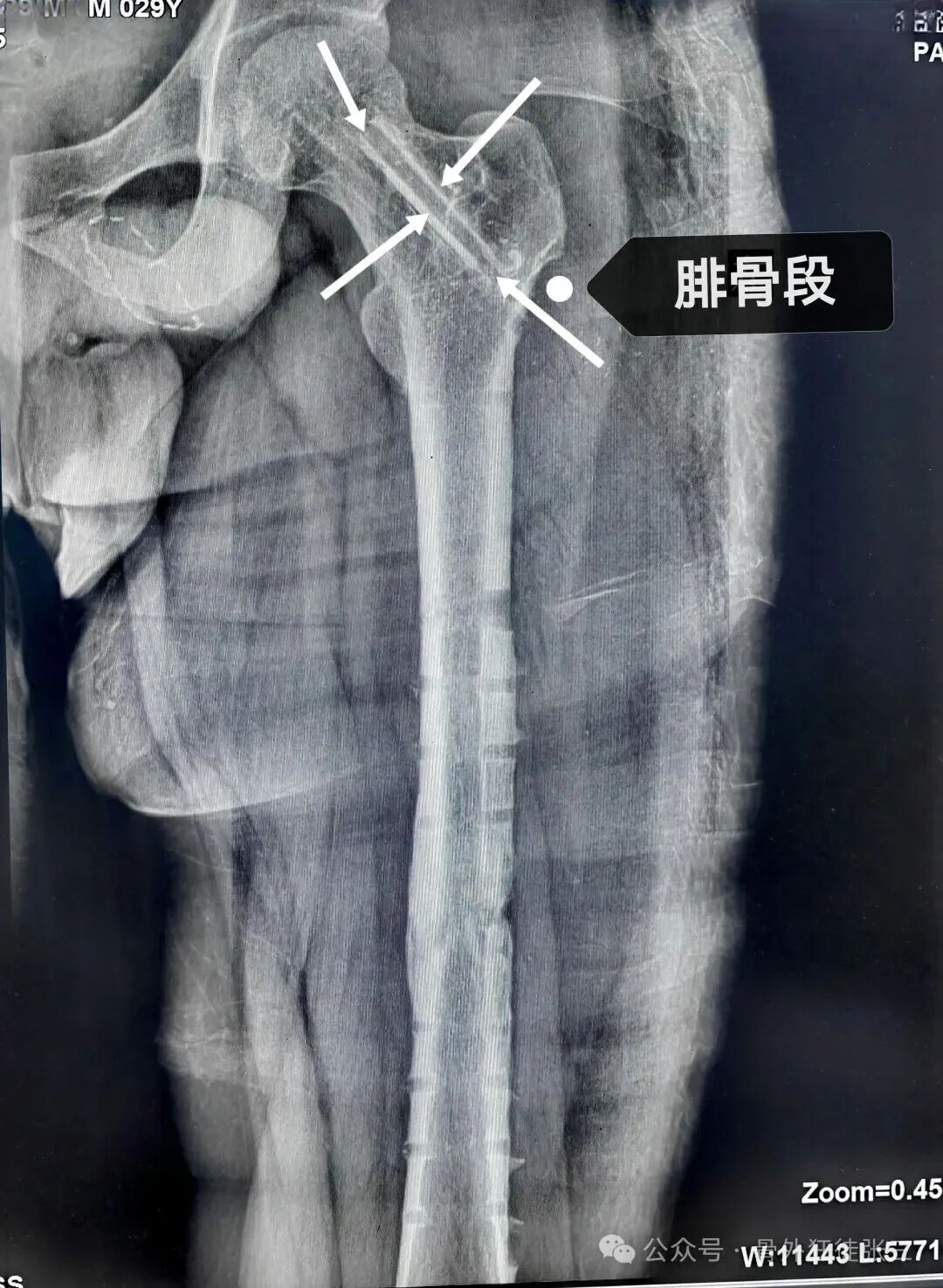 两例锁定板动力化，长势喜人！