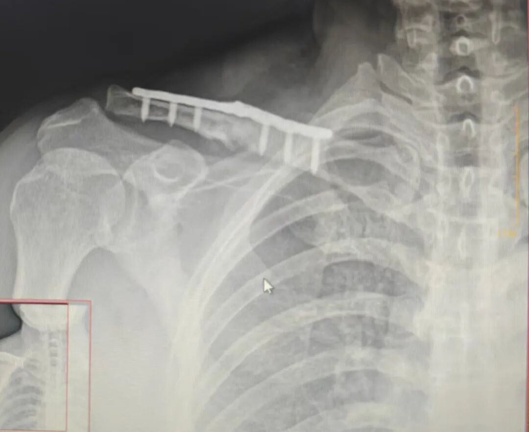 无“为“而治：锁骨断板，必须手术翻修吗？