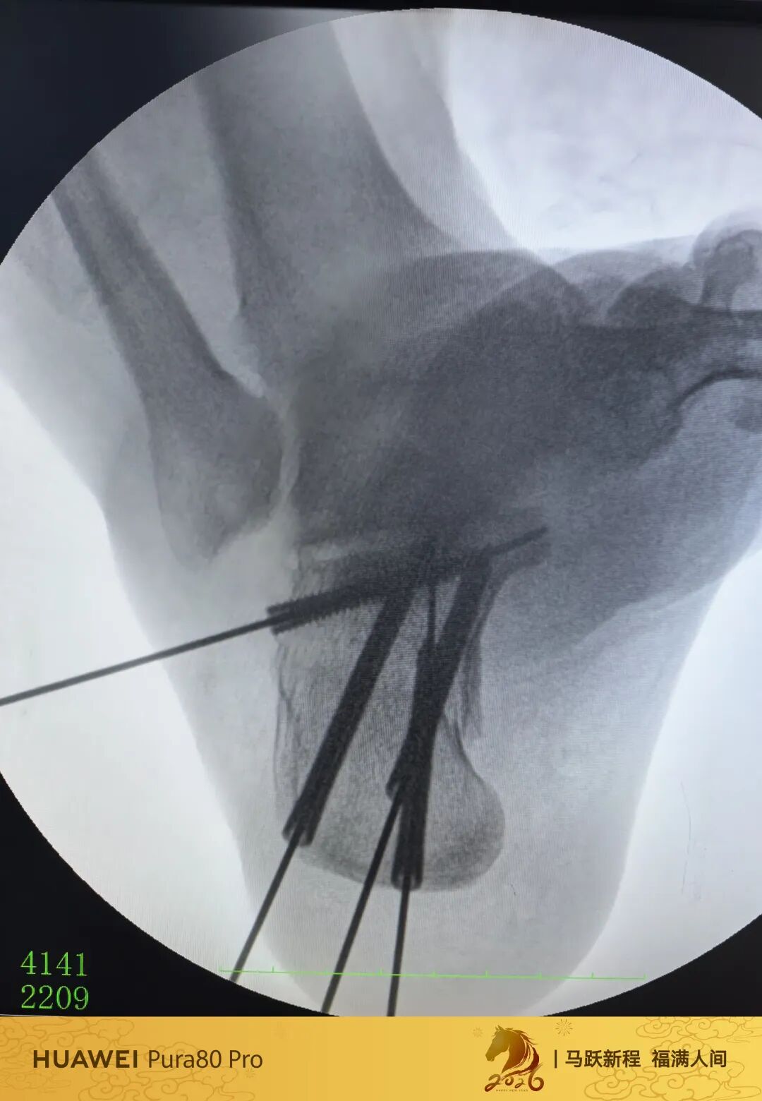 跟骨微创，无需等待消肿，无需担心切口感染、皮肤坏死