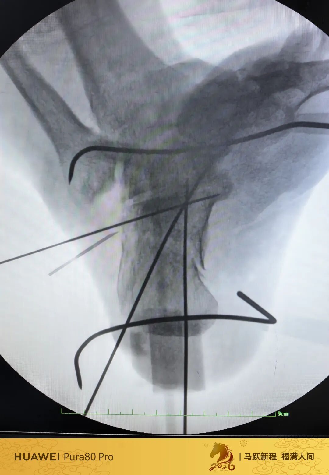 跟骨微创，无需等待消肿，无需担心切口感染、皮肤坏死
