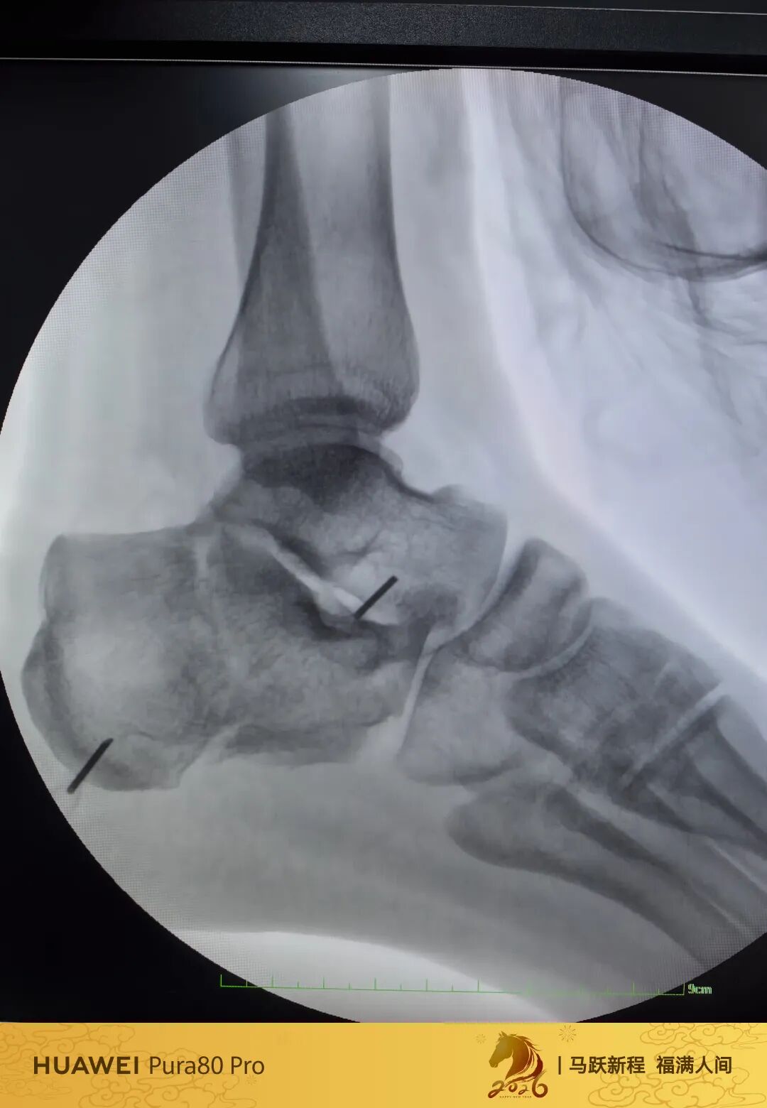 跟骨微创，无需等待消肿，无需担心切口感染、皮肤坏死