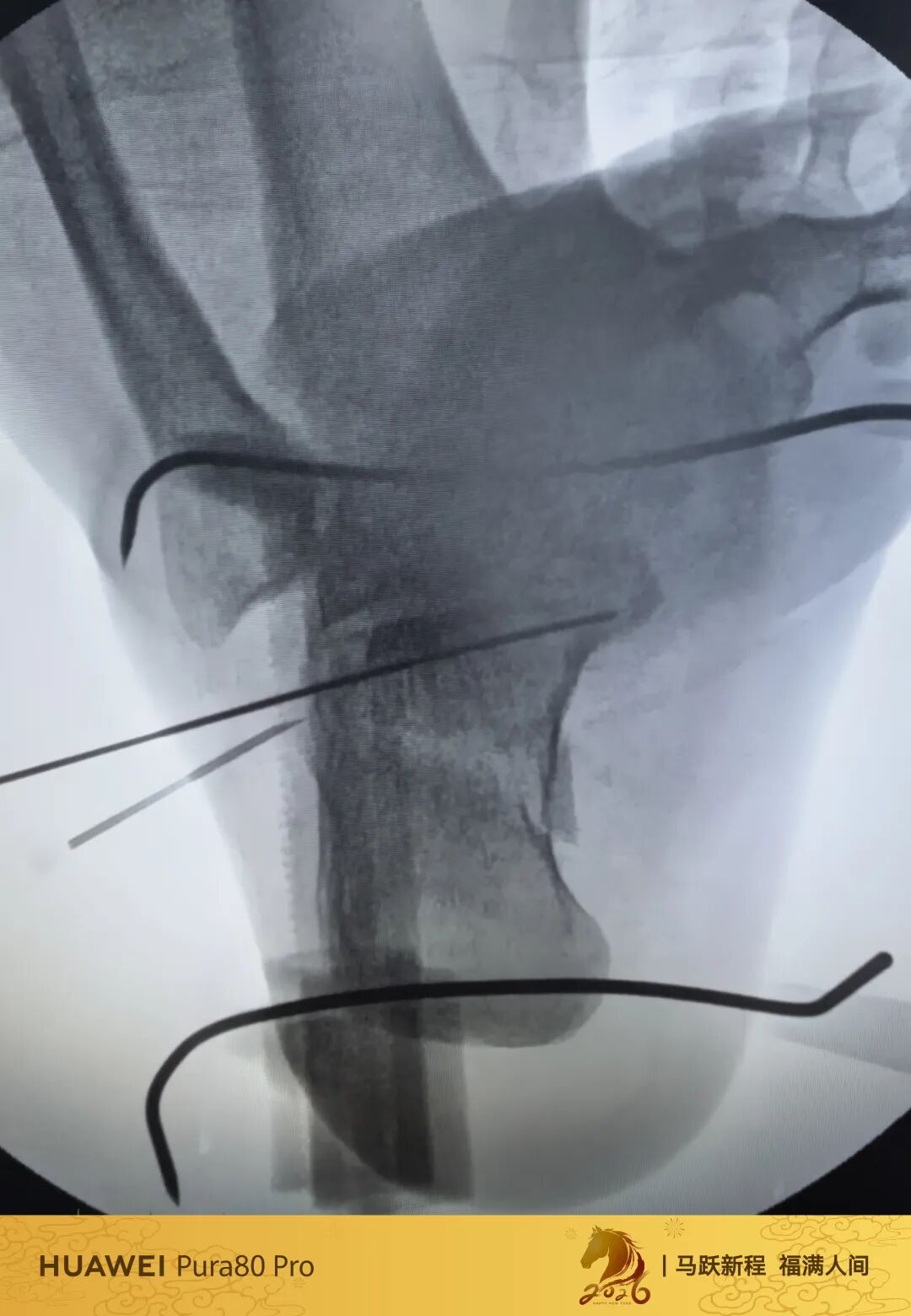 跟骨微创，无需等待消肿，无需担心切口感染、皮肤坏死