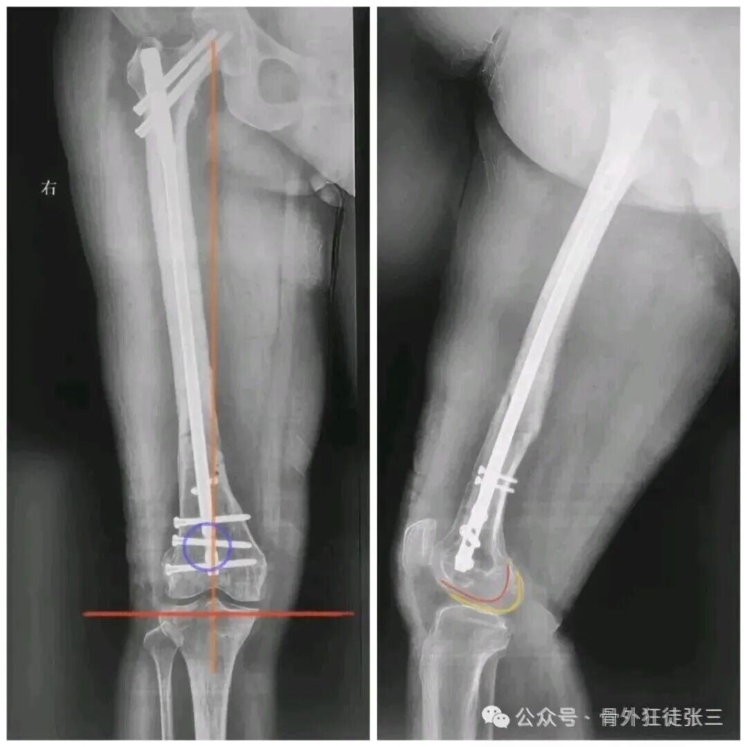 股骨干骨折为什么要“顶天立地”“能顺行不逆行”