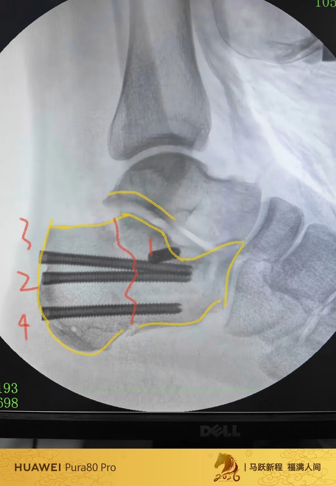 跟骨微创，无需等待消肿，无需担心切口感染、皮肤坏死