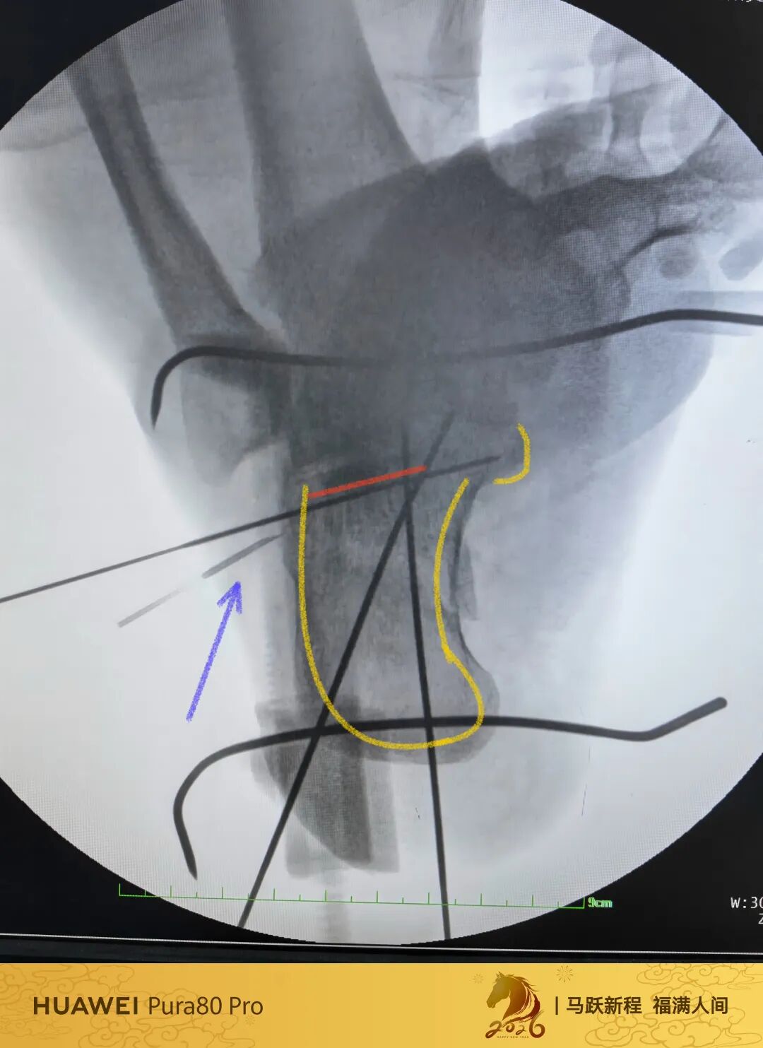 跟骨微创，无需等待消肿，无需担心切口感染、皮肤坏死