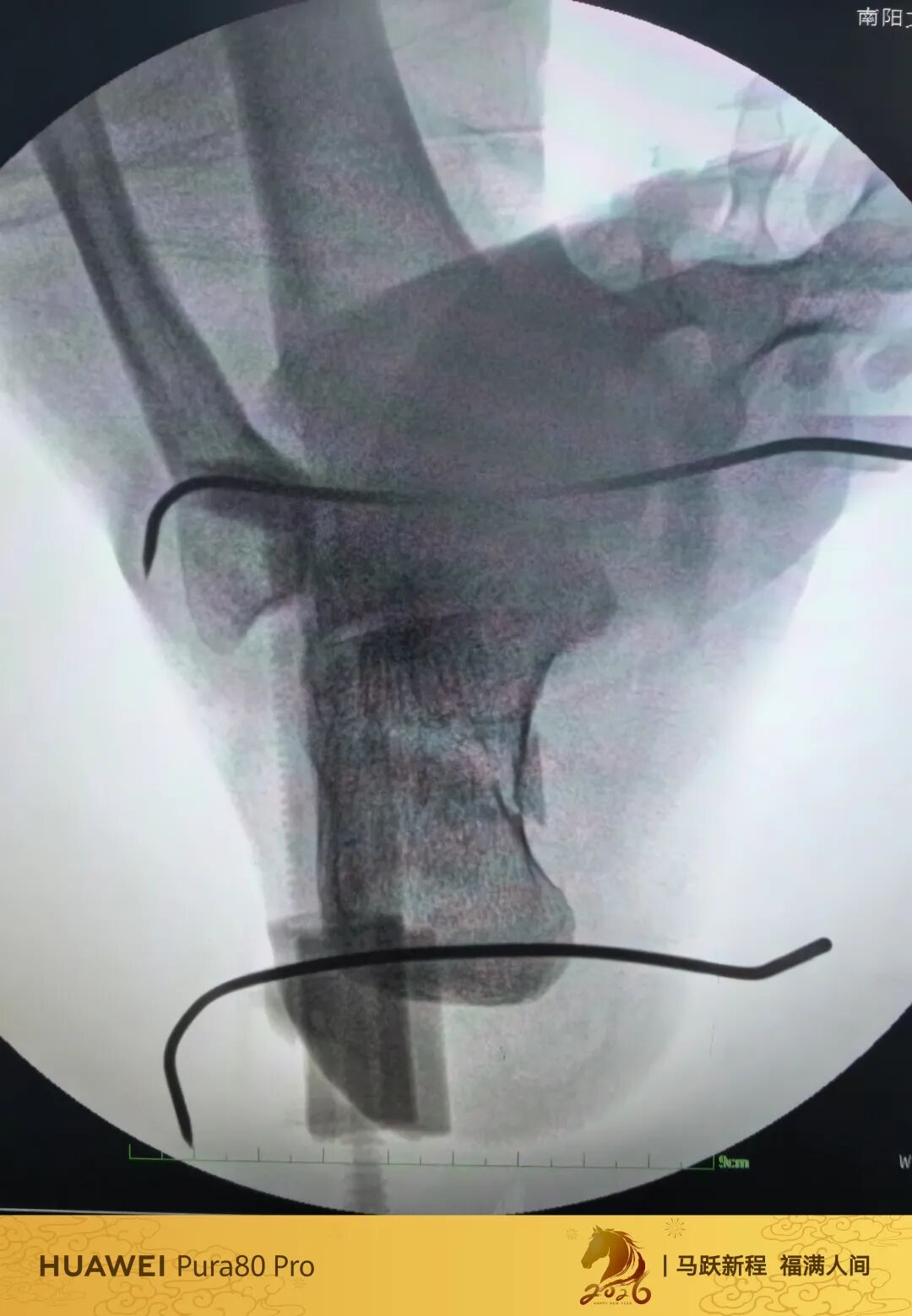 跟骨微创，无需等待消肿，无需担心切口感染、皮肤坏死