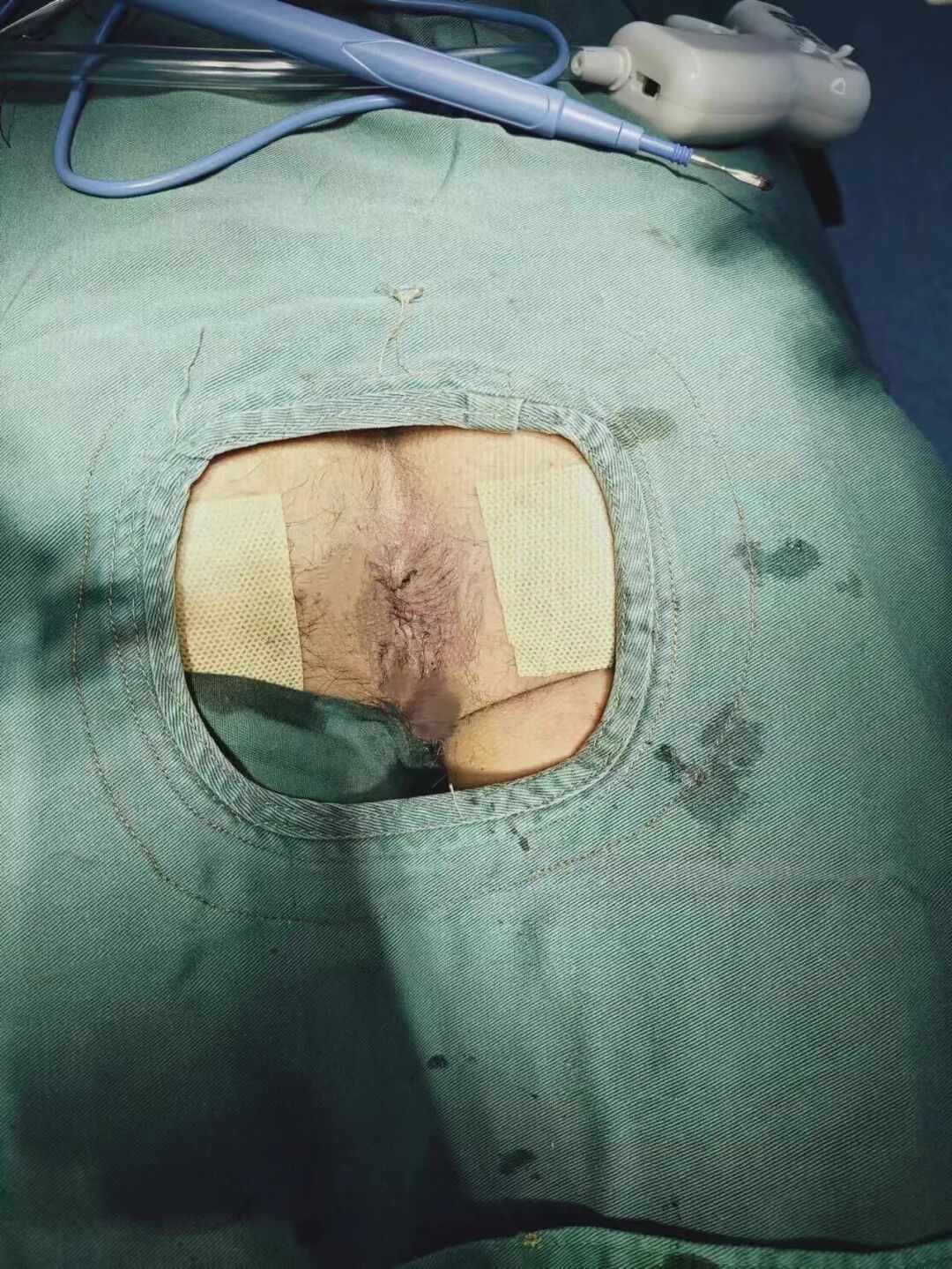 痔疮套扎吻合器怎么用痔疮微创治疗新技术——自动弹力线痔疮套扎术_https://www.jmylbn.com_新闻资讯_第11张