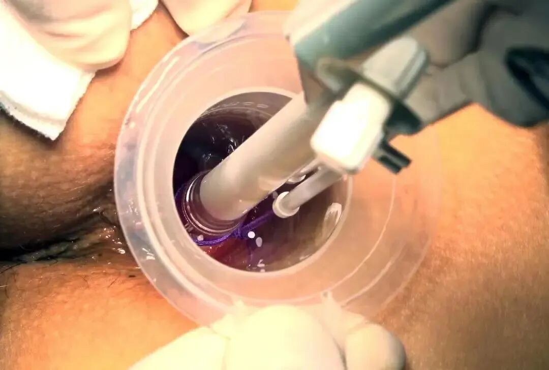 痔疮套扎吻合器怎么用痔疮微创治疗新技术——自动弹力线痔疮套扎术_https://www.jmylbn.com_新闻资讯_第14张