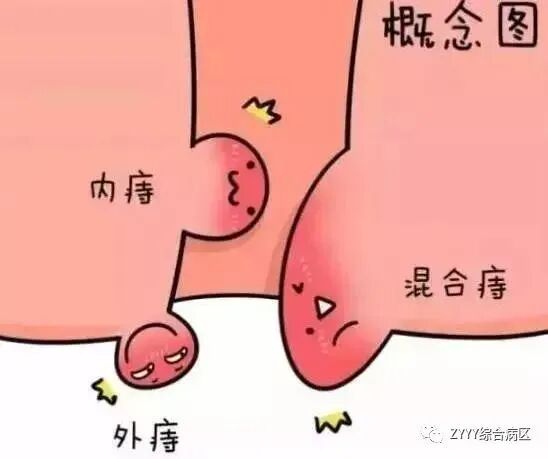 痔疮套扎吻合器怎么用痔疮微创治疗新技术——自动弹力线痔疮套扎术_https://www.jmylbn.com_新闻资讯_第15张