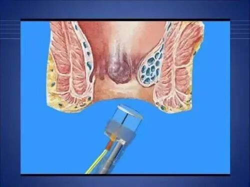 痔疮套扎吻合器怎么用痔疮微创治疗新技术——自动弹力线痔疮套扎术_https://www.jmylbn.com_新闻资讯_第8张