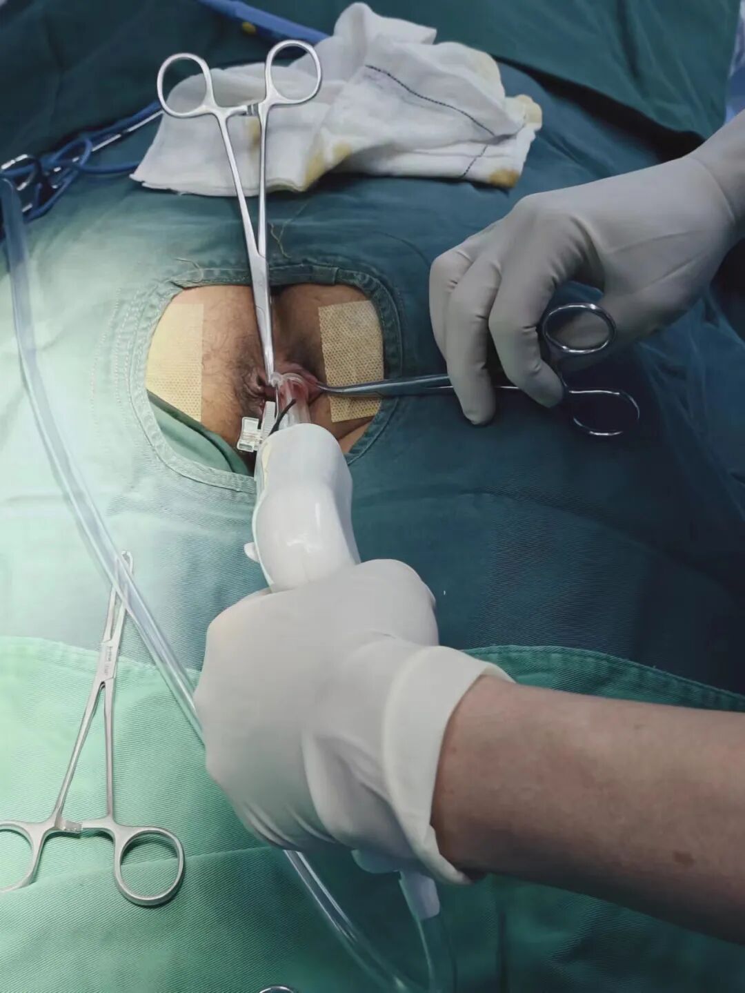 痔疮套扎吻合器怎么用痔疮微创治疗新技术——自动弹力线痔疮套扎术_https://www.jmylbn.com_新闻资讯_第9张