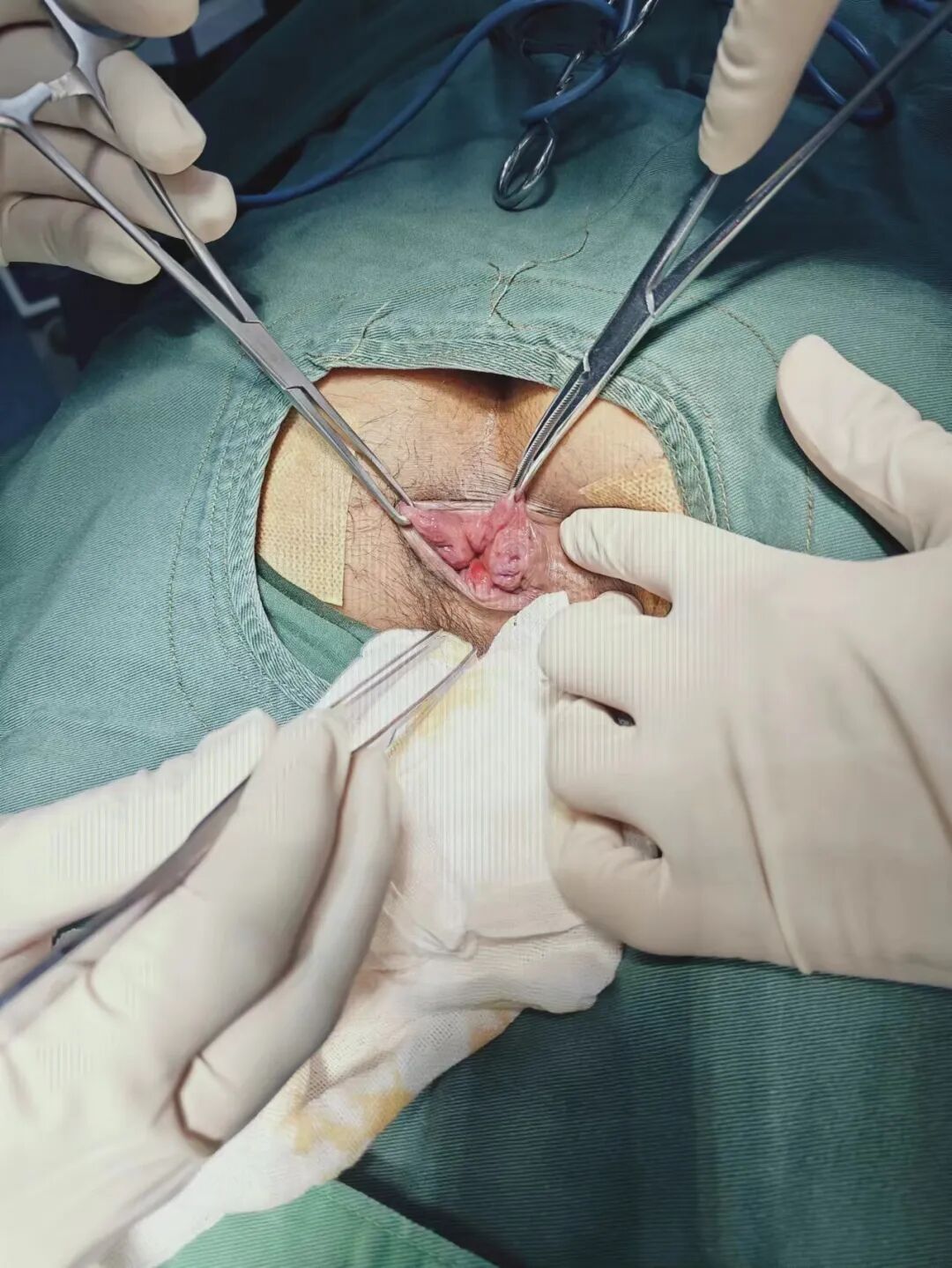 痔疮套扎吻合器怎么用痔疮微创治疗新技术——自动弹力线痔疮套扎术_https://www.jmylbn.com_新闻资讯_第10张