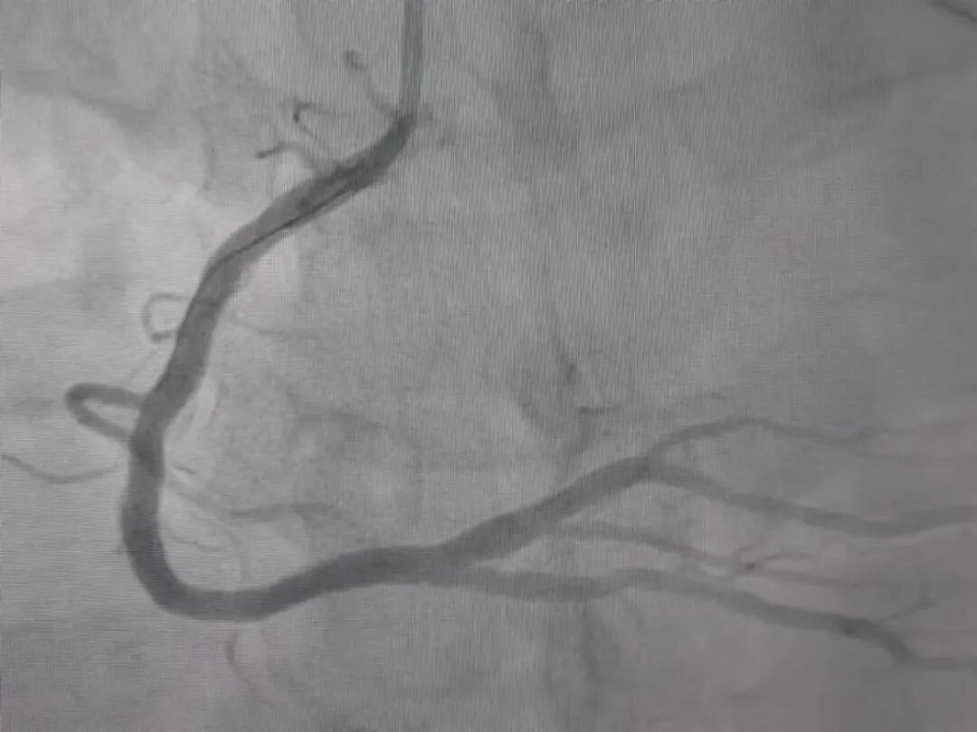 27岁小伙突发心梗连夜送医抢救原因扎心了很多人都中招