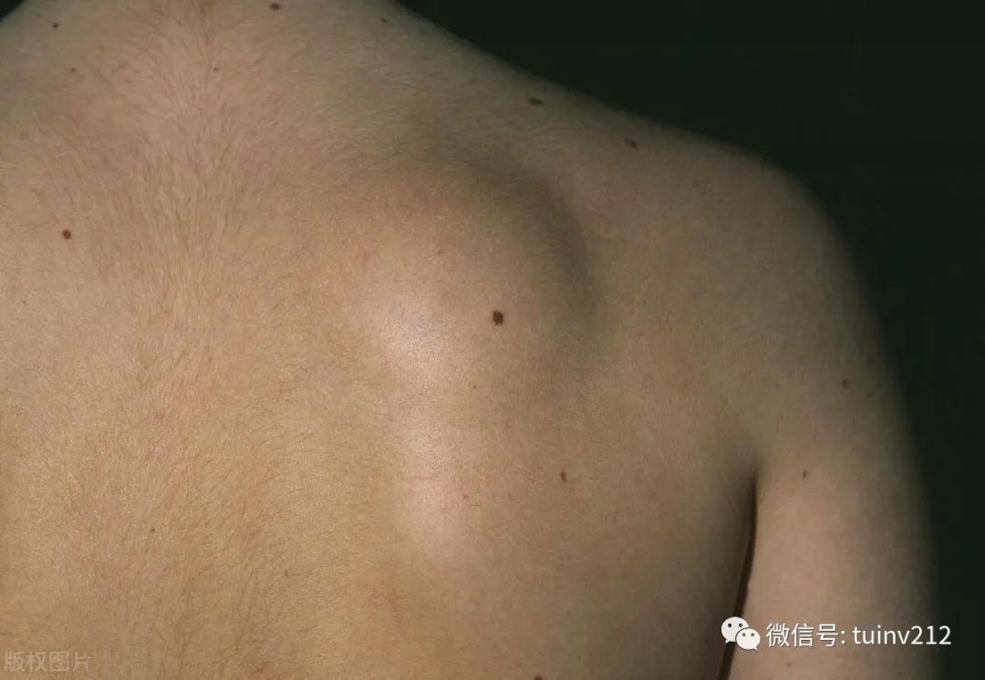 脂肪瘤和脂肪肉瘤，一字之差，却有良恶之分，医生教您辨别